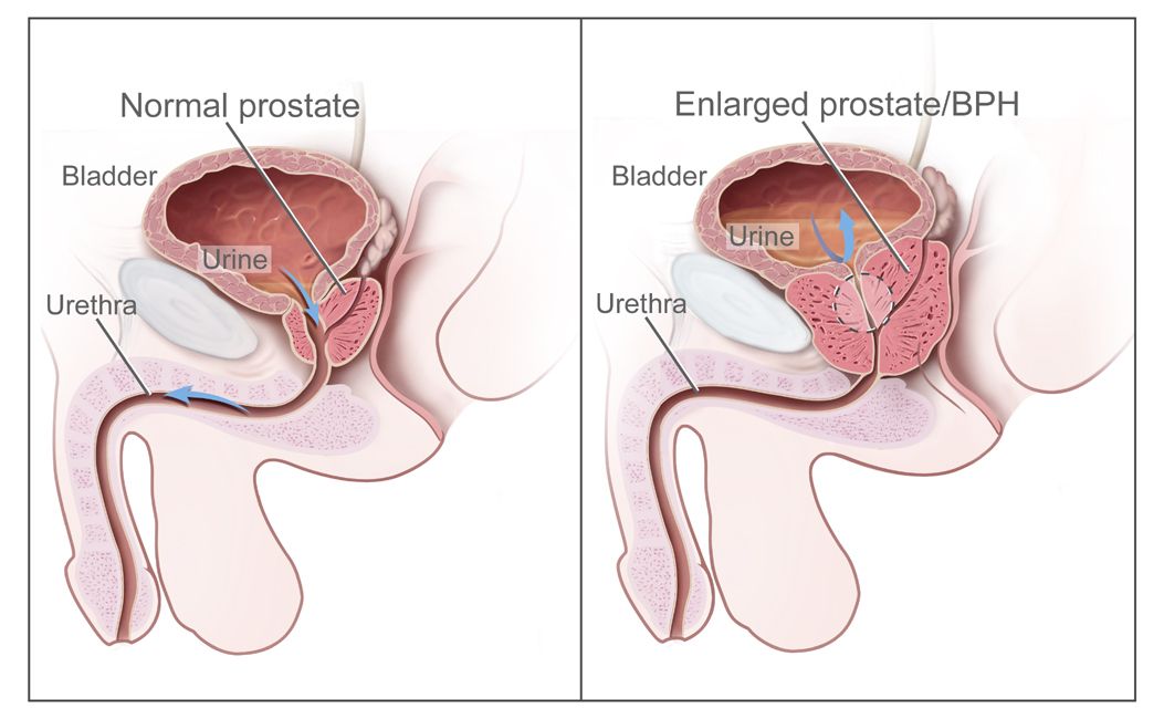 10 Powerful Health Benefits of Sex  Lowers the Risk of Prostate Cancer