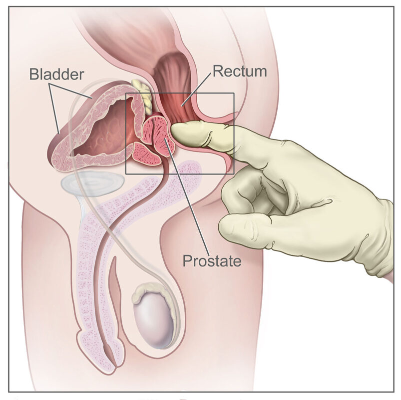 Prostate Ejaculation