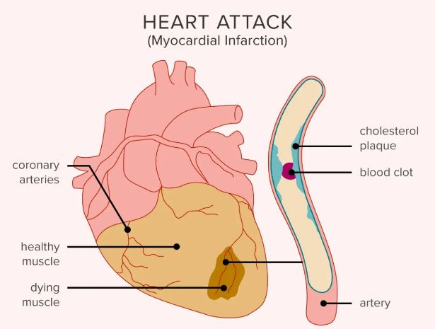 Sex after a heart attack 